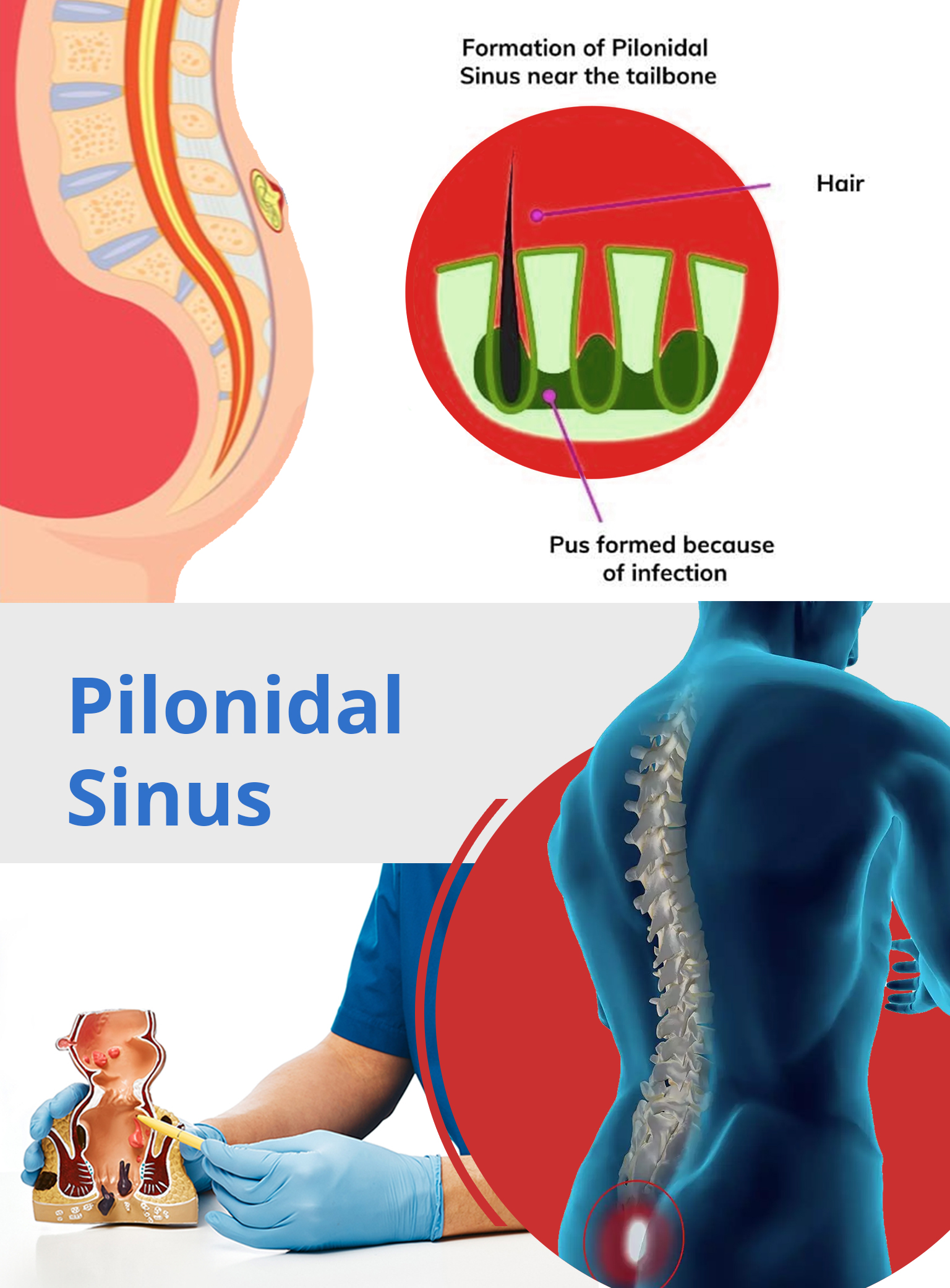 Pilonidal Cyst With Sinus Tract CBFTS